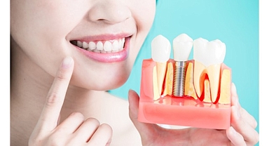 Diş İmplantları Hakkında Bilmeniz Gereken 9 Bilgi!